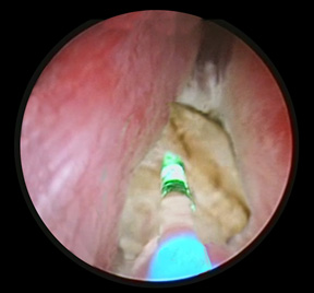 prostata03