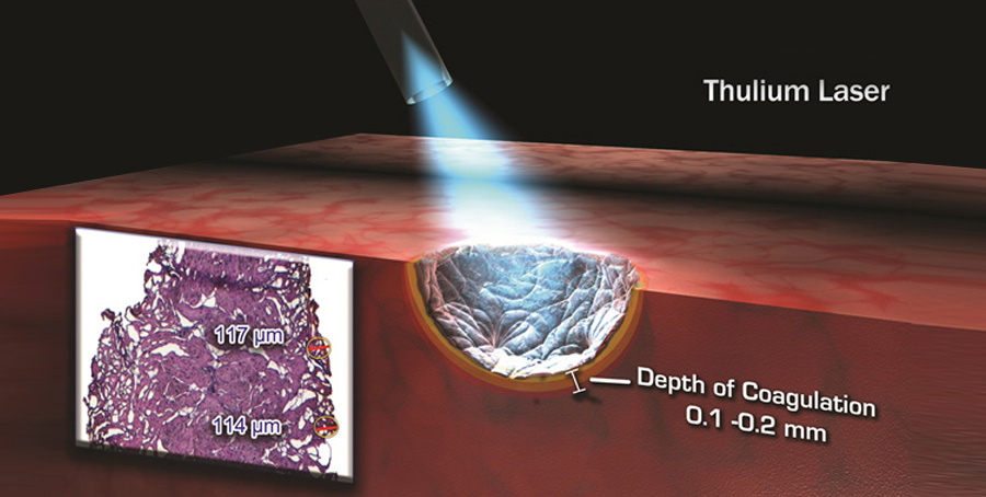 Thulium Laser
